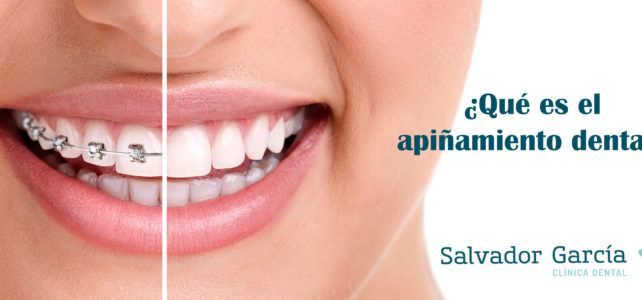 ¿Qué es el apiñamiento dental?