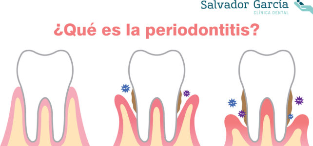 ¿Qué es la periodontitis?