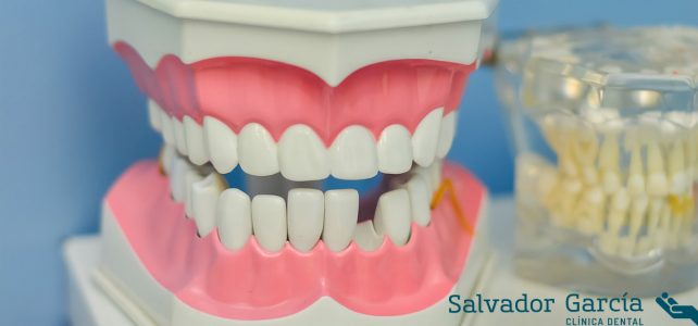 ¿Qué son las caries y cómo tratarlas?