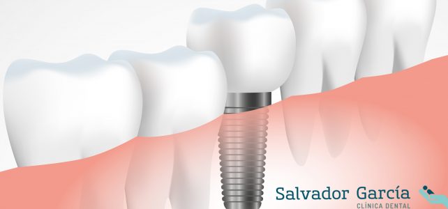 Los implantes dentales, su cuidado y mantenimiento