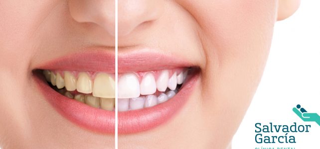 Dentista en Málaga: ¿Qué es la blancorexia?