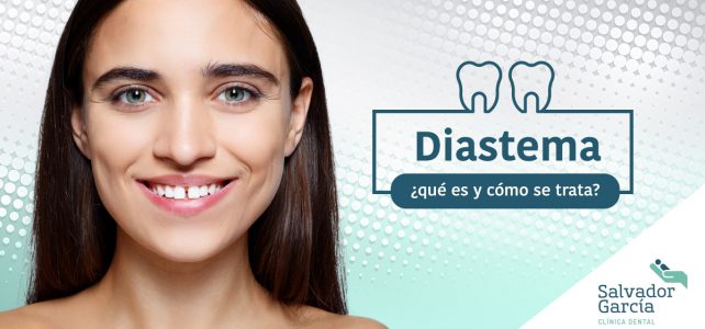 Diastema dental, ¡no más espacio entre tus dientes!