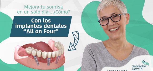 Implantes all on four: ¡cambia tu sonrisa en un solo día!