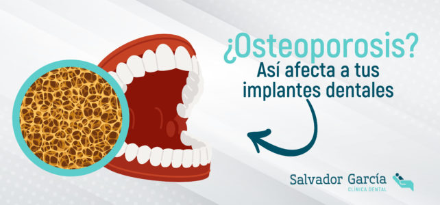 ¿Osteoporosis? Claves para el éxito de tus implantes dentales