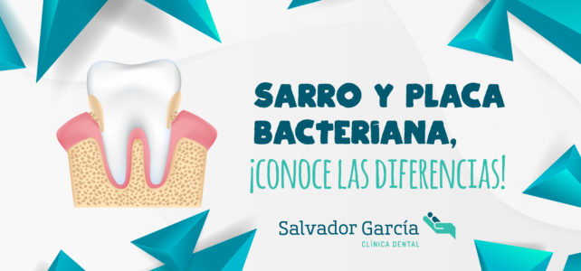 El sarro y la placa bacteriana, ¿conoces la diferencia?