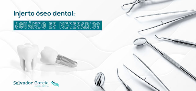 Injerto de hueso dental, ¿cuándo se realiza este tratamiento?