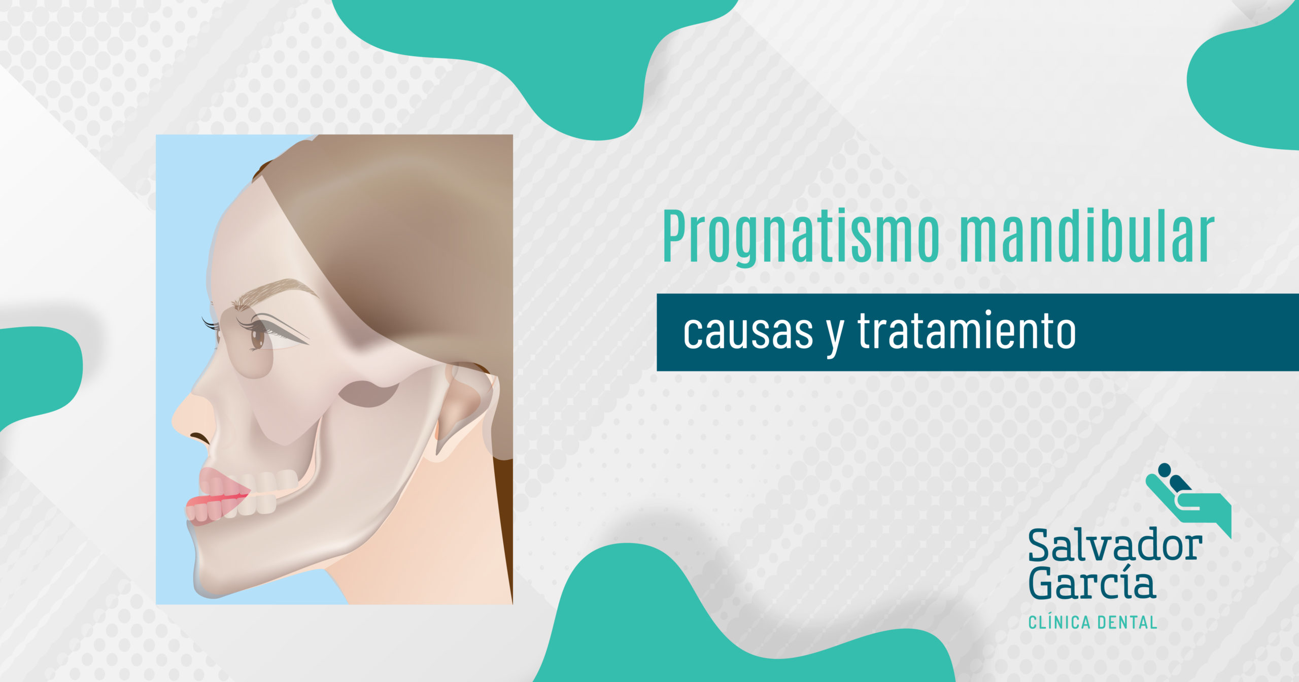 ferpa on X: prognatismo mandibular (maxilar inferior proeminente