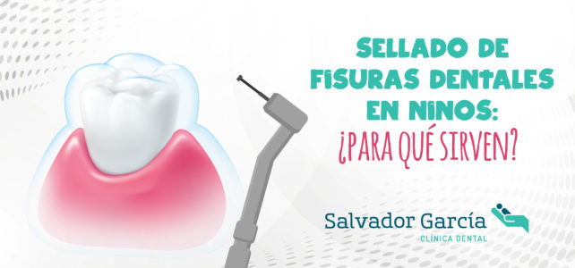 Sellado de fisuras dentales: la importancia de la odontopediatría