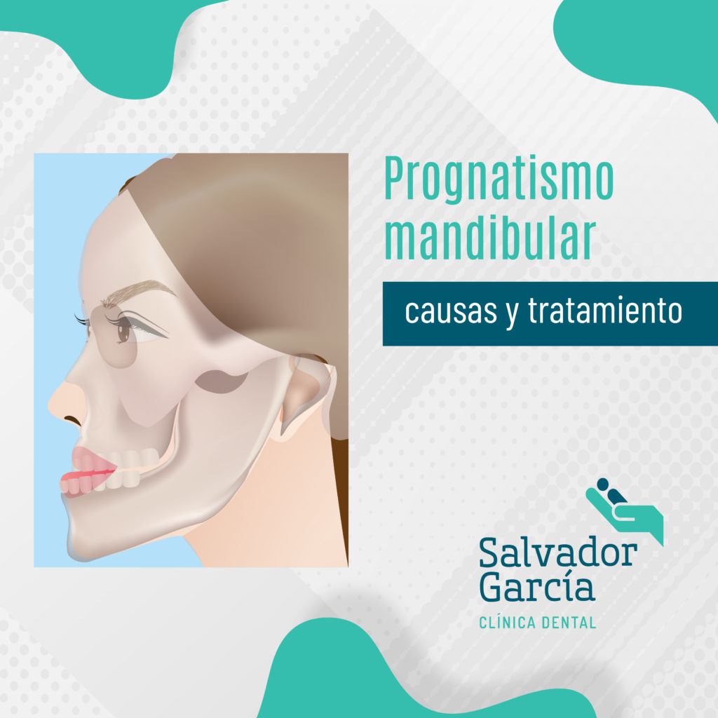 prognatismo mandibular
