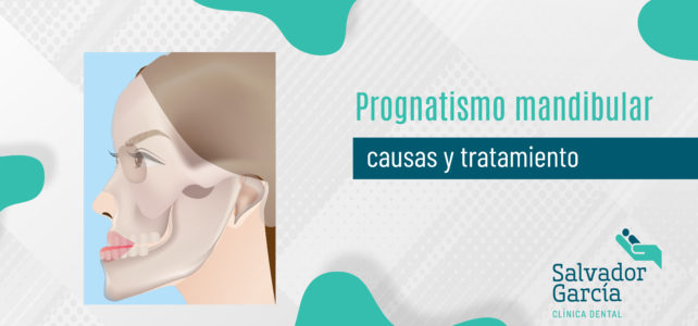 Prognatismo mandibular, causas y tratamiento