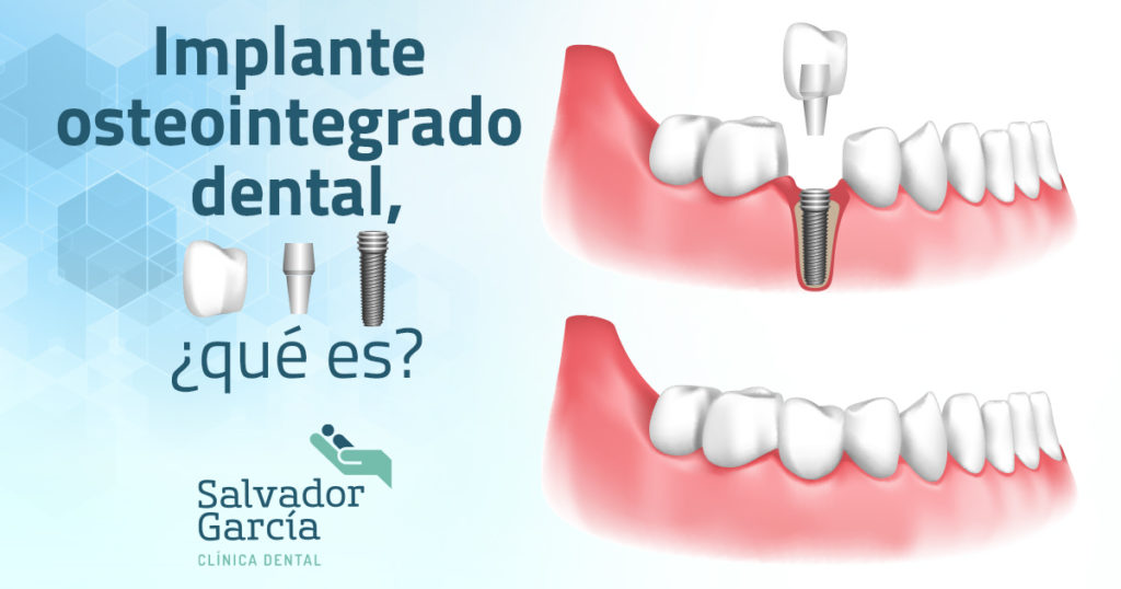 Implantes Dentales en CDMX