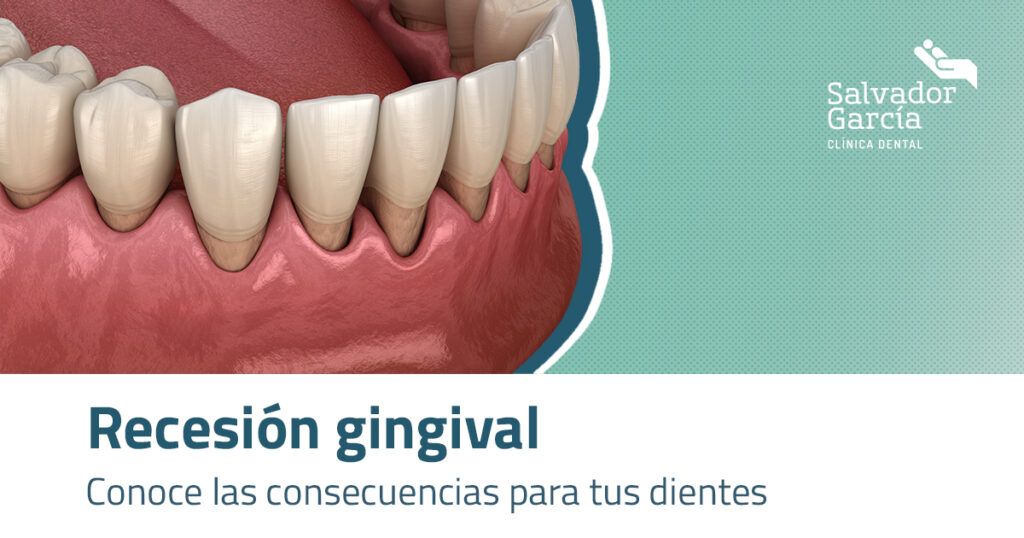 Recesión Gingival. Conoce las consecuencias para tus dientes