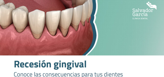 Recesión gingival. Conoce las consecuencias para tus dientes