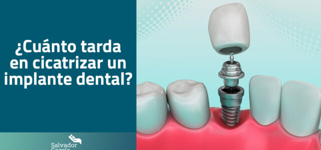 ¿Cuánto tarda en cicatrizar un implante dental?