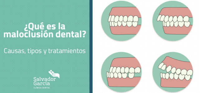 ¿Qué es la maloclusión dental?