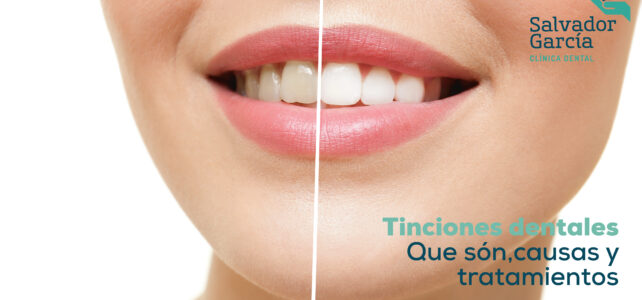 Tinciones Dentales: ¿Cómo tratarlas?