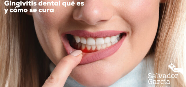 ¿Qué es la gingivitis dental? Síntomas y tratamiento