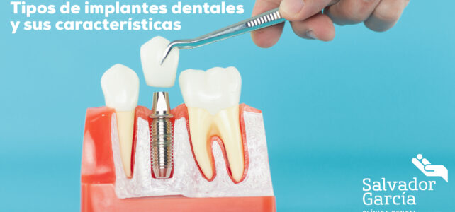 Características y tipos de implantes dentales