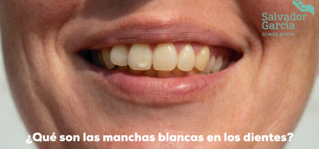 Qué son y por qué salen manchas blancas en los dientes