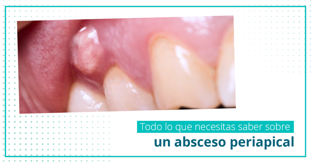 Abceso periapical
