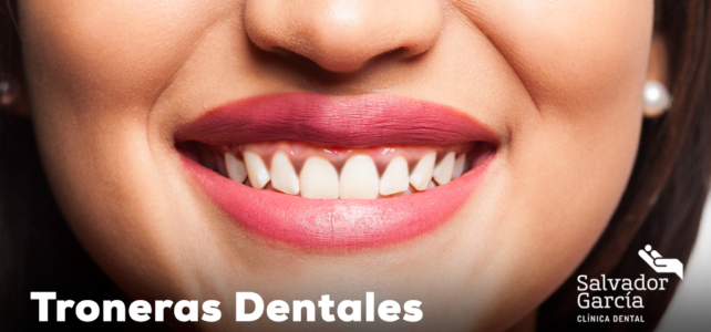 Troneras dentales: Qué son y cómo tratarlas