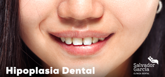 Hipoplasia dental o del esmalte en niños y adultos