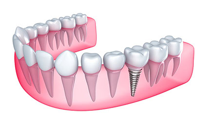 cuanto vale un implante dental